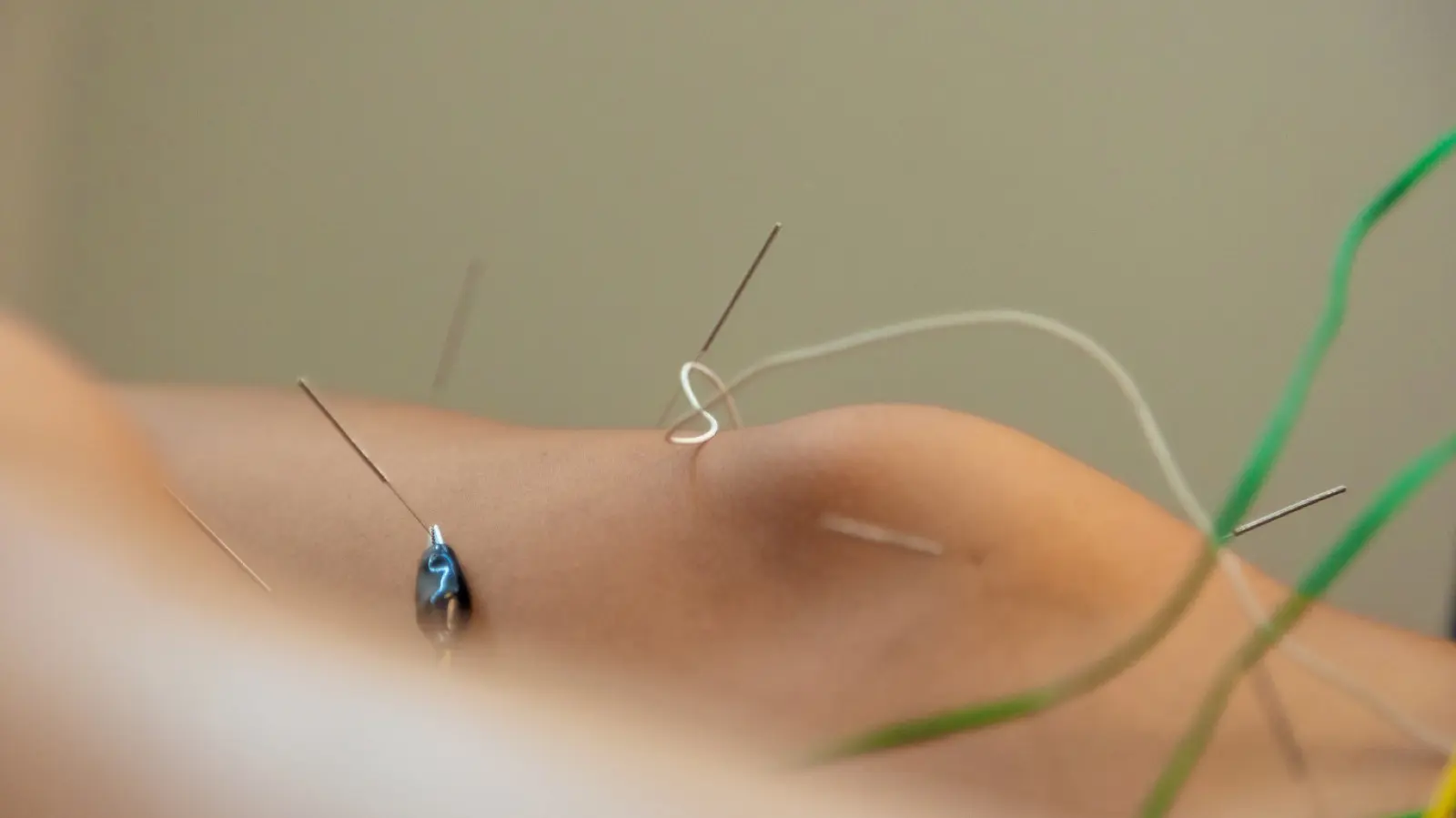 Acupuncture on knee